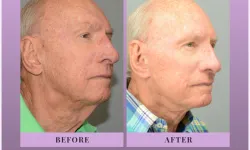 Thumbnail control image for Best Necklift Case Study 6 Facial Aesthetic Surgery
