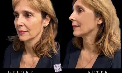 Thumbnail control image for Best Necklift Case Study 8 Facial Aesthetic Surgery