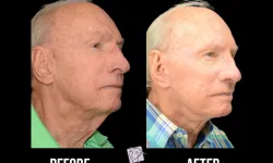 Thumbnail control image for Best Facelift Atlanta Case Study 8 Facial Aesthetic Surgery
