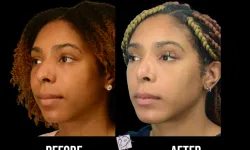 Thumbnail control image for Best Chin Liposuction & Tightening Before & After Case Study 6