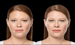 Thumbnail control image for Best KYBELLA® Atlanta Case Study 2 Facial Aesthetic Surgery