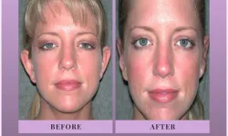 Thumbnail control image for Best Otoplasty Atlanta Case Study 2 Facial Aesthetic Surgery