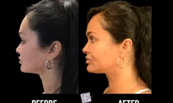 Thumbnail control image for Best Eyes Closed Case Study 1  Facial Aesthetic Surgery