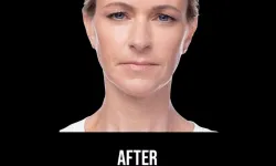 Thumbnail control image for Best Dysport Atlanta Case Study 2 Facial Aesthetic Surgery