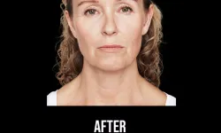 Thumbnail control image for Best Dysport Atlanta Case Study 10 Facial Aesthetic Surgery