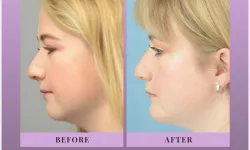 Thumbnail control image for Best Chin Implant Atlanta Case Study 2 Facial Aesthetic Surgery