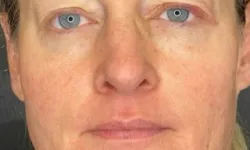 Thumbnail control image for RF Microneedling Atlanta Case Study 10 Facial Aesthetic Surgery
