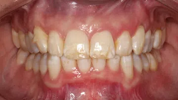 Close-up of upper and lower teeth showing white spots and plaque buildup on yellowish enamel with red gums.
