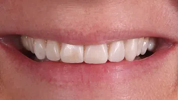 Close-up of a smiling mouth showing white, well-aligned teeth with natural texture and light staining.