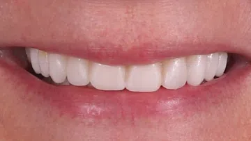 Close-up of a smiling mouth showing white, well-aligned teeth with natural texture and light staining.