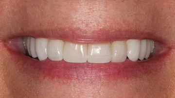 Close-up of a person's smile showing white, straight teeth and natural lips.