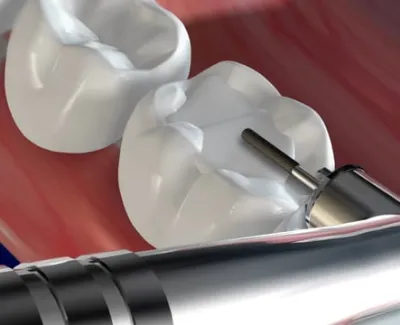 Dental Fillings