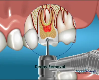 Dental drill removing tooth decay from inside a molar with highlighted inflammation and decay removal label.