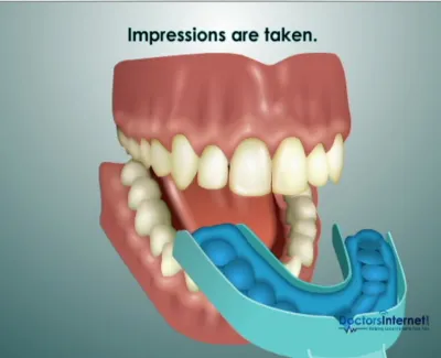 3D illustration of dental impression tray fitting over lower teeth with text Impressions are taken