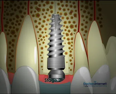 Cross-section of dental implant in jawbone showing stage 2 with surrounding natural teeth and gums.