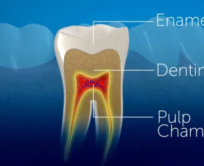Root Canal