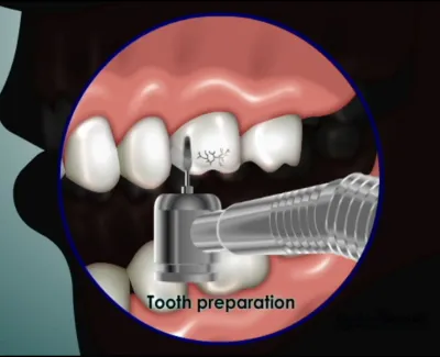 Dental drill used for tooth preparation on a cracked tooth in the upper jaw.