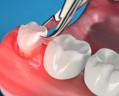 Extractions