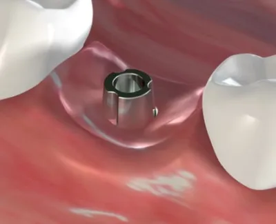 Dental Implants