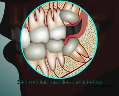 Dental illustration showing soft tissue inflammation and infection around a partially erupted wisdom tooth.