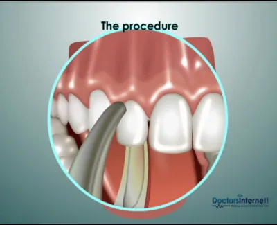 Dental procedure illustration showing a dental tool working on a tooth next to healthy teeth and gums.