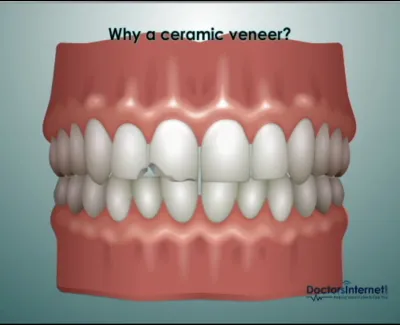 3D dental illustration showing damaged teeth and the benefits of ceramic veneers for restoration.