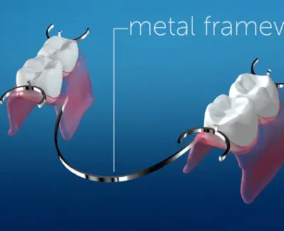 Dentures