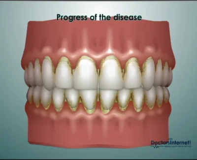 Dental illustration showing progression of gum disease with plaque buildup and inflamed gums around teeth.