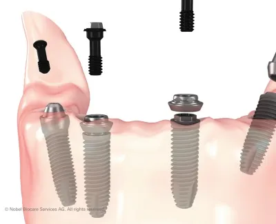 All on 4 Dental Implants