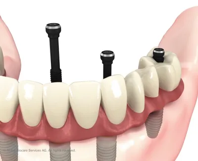 Full Arch Implant Bridge