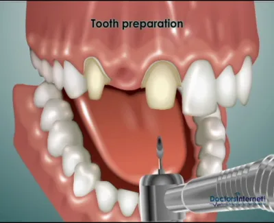 Dental illustration showing tooth preparation with dental drill on upper front teeth for crown placement.