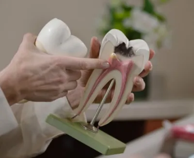 Root Canal
