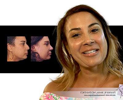Rhinoplasty Real Patient Story