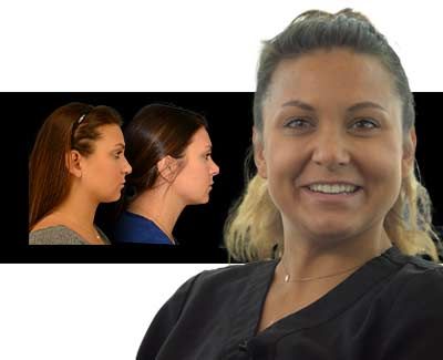 Rhinoplasty Real Patient Story