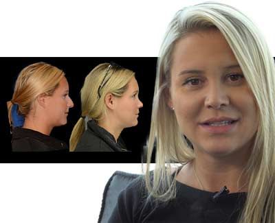 Rhinoplasty Real Patient Story