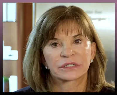 Facelift Real Patient Story
