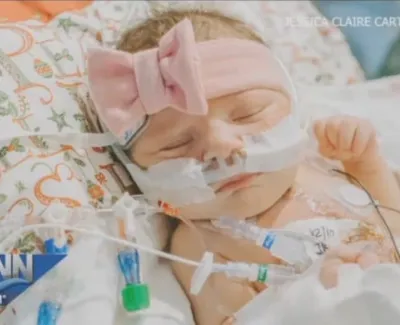 Sleeping infant with medical tubes and breathing support, wearing a pink bow headband in hospital.