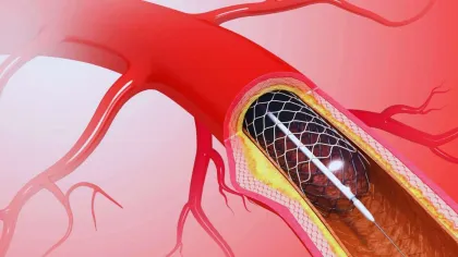3D illustration of artery with stent placement to treat plaque buildup and restore blood flow