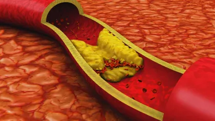 3D illustration of a clogged artery with yellow plaque buildup and red blood cells inside a blood vessel.