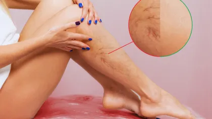 Close-up of a woman's legs showing spider veins with a highlighted inset of the affected skin area.