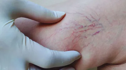 Close-up of gloved hand examining spider veins on human skin, highlighting visible red and purple veins.