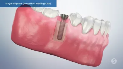 3D illustration of a single posterior dental implant with a healing cap inside the lower jaw gum tissue.