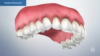 3D illustration of upper teeth and gums showing gingival recession with exposed tooth roots.