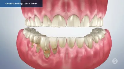 3D illustration showing upper and lower teeth with varying degrees of tooth wear and gum tissue.