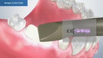 3D dental CAD/CAM bridge design process showing a digital tool scanning missing teeth area in the lower jaw.