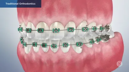 Close-up 3D rendering of teeth with traditional orthodontic metal braces and green brackets on upper and lower jaws