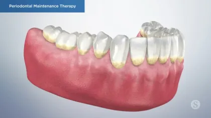3D illustration of lower teeth and gums showing plaque buildup for periodontal maintenance therapy.