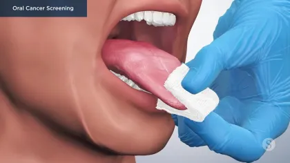 Close-up of oral cancer screening showing a gloved hand examining a patient's tongue with gauze.