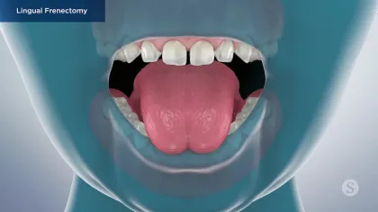 3D illustration of an open mouth showing the tongue and teeth for lingual frenectomy procedure.