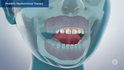 3D medical illustration showing pediatric myofunctional therapy with a focus on tongue, teeth, and jaw alignment.
